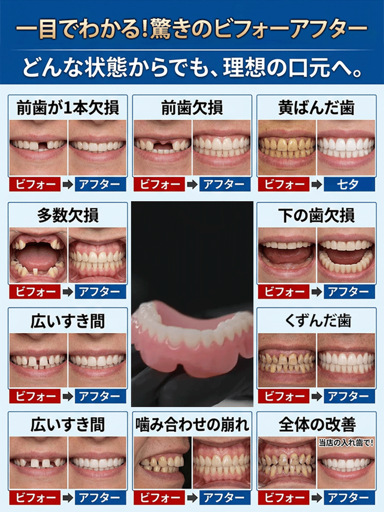 【自信あふれる笑顔】多機能フルセット入れ歯